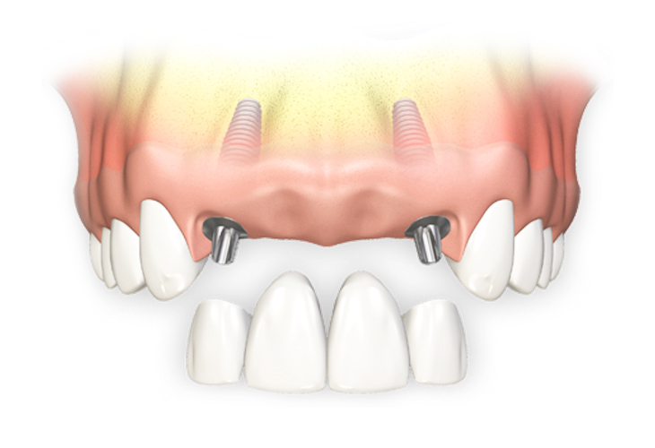 Имплантация передних зубов в москве
