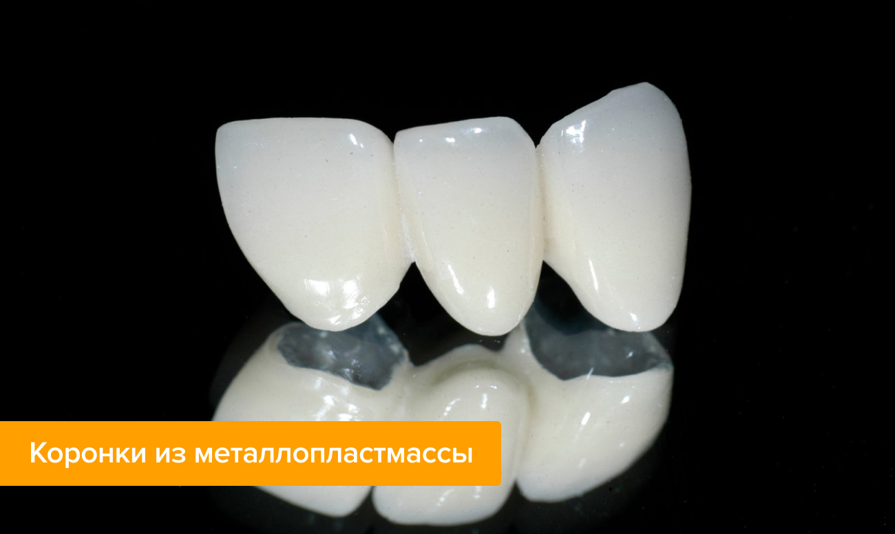 Металлопластмассовые коронки на зубы