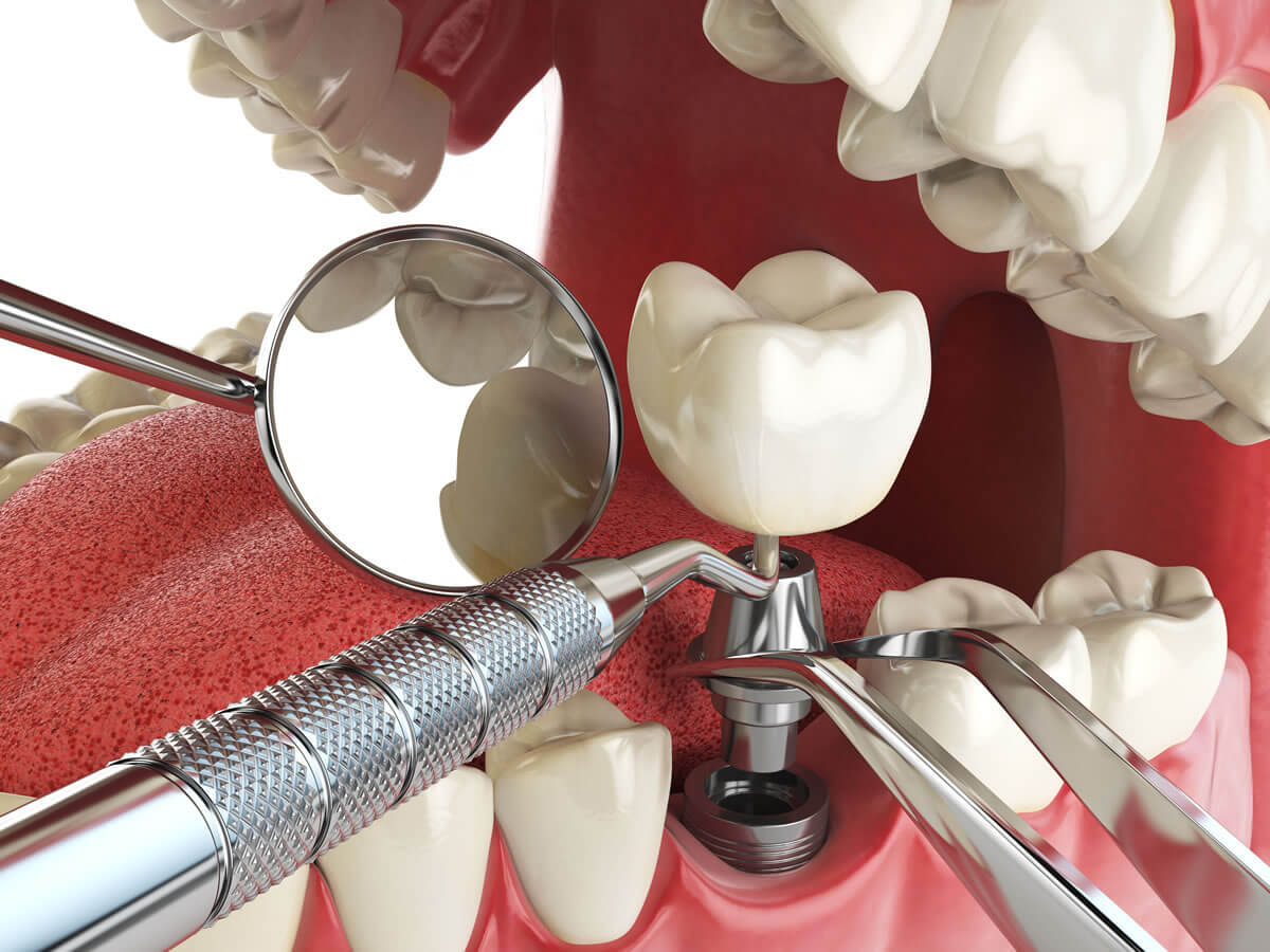 implantazia zubov photo 2